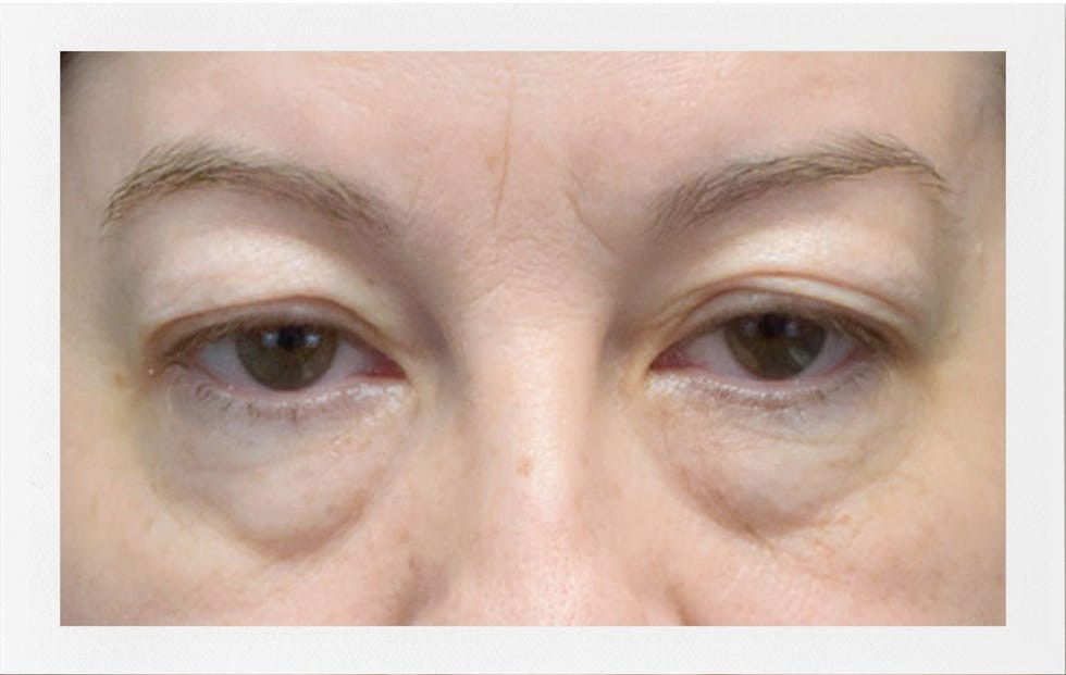 Close-up of a person's eyes showing slight puffiness and uneven eyelid appearance.